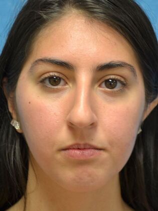 Rhinoplasty Case 1501- Toledo, OH - Before