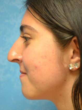 Rhinoplasty: Case 1501- Toledo, OH - Before