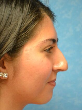 Rhinoplasty: Case 1501- Toledo, OH - Before