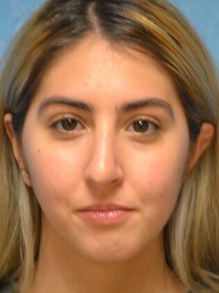 Rhinoplasty Case 1501- Toledo, OH - After