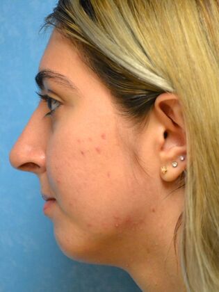 Rhinoplasty: Case 1501- Toledo, OH - After