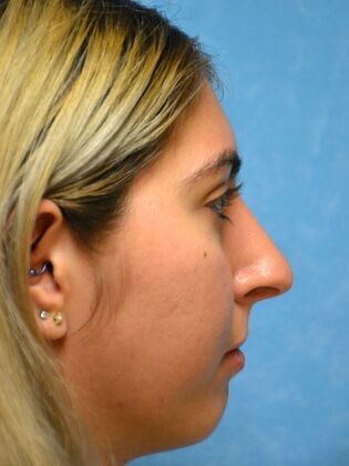 Rhinoplasty: Case 1501- Toledo, OH - After