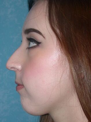 Rhinoplasty: Case 1502- Sylvania, OH - Before