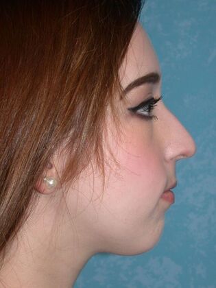 Rhinoplasty: Case 1502- Sylvania, OH - Before