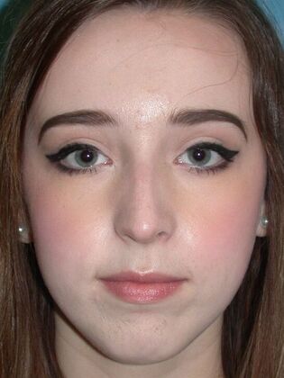 Rhinoplasty Case 1502- Sylvania, OH - Before