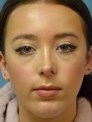 Rhinoplasty Case 1502- Sylvania, OH - After