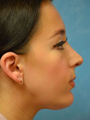Rhinoplasty: Case 1502- Sylvania, OH - After