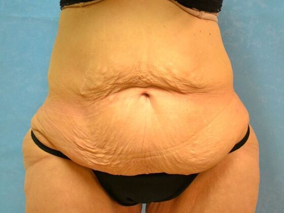 Tummy Tuck Case 1801- Saginaw, MI - Before
