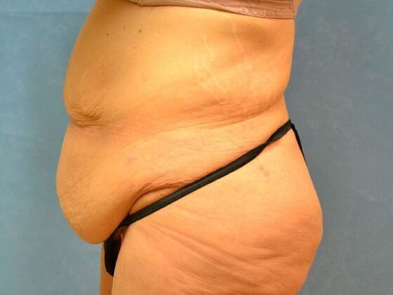 Tummy Tuck: Case 1801- Saginaw, MI - Before