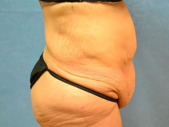 Tummy Tuck: Case 1801- Saginaw, MI - Before