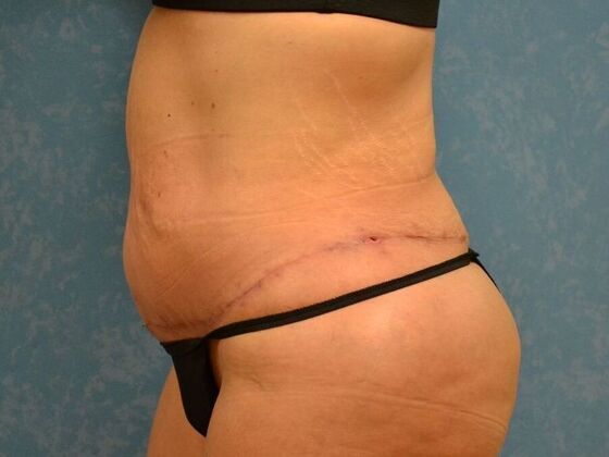 Tummy Tuck: Case 1801- Saginaw, MI - After