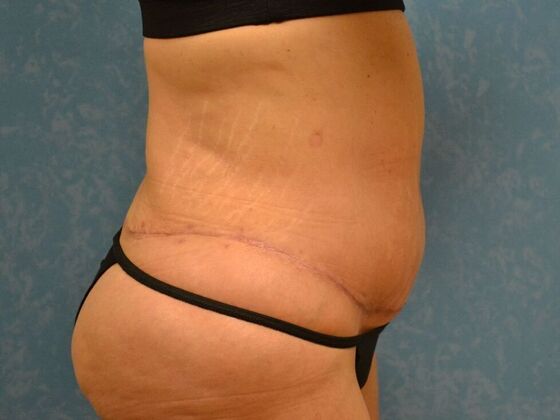 Tummy Tuck: Case 1801- Saginaw, MI - After