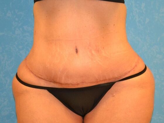 Tummy Tuck: Case 1801- Saginaw, MI - After