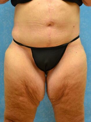 Bodylift Case 1529- Fostoria, OH - After