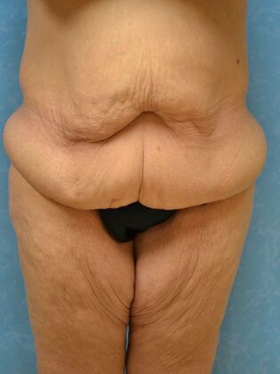 Bodylift Case 1529- Fostoria, OH - Before