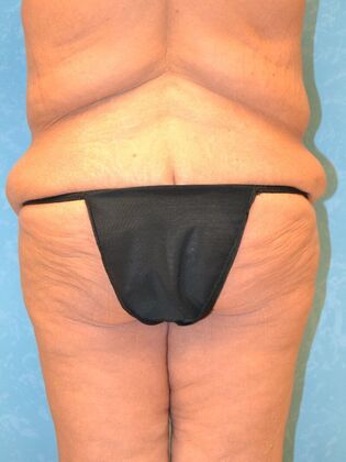 Bodylift: Case 1529- Fostoria, OH - Before