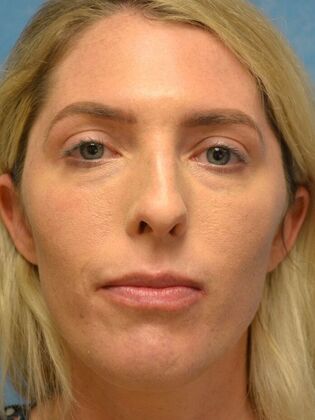 Rhinoplasty Case 1503- Sylvania, OH - Before