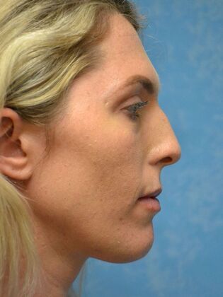 Rhinoplasty: Case 1503- Sylvania, OH - Before