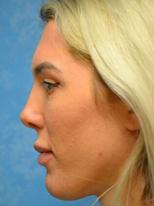 Rhinoplasty: Case 1503- Sylvania, OH - After