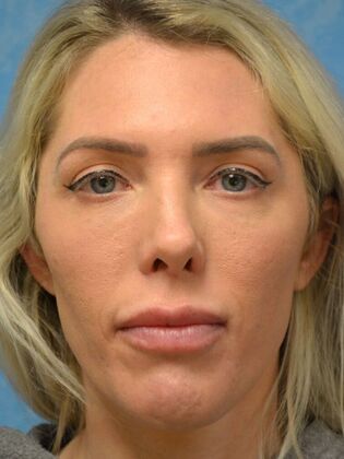 Rhinoplasty Case 1503- Sylvania, OH - After