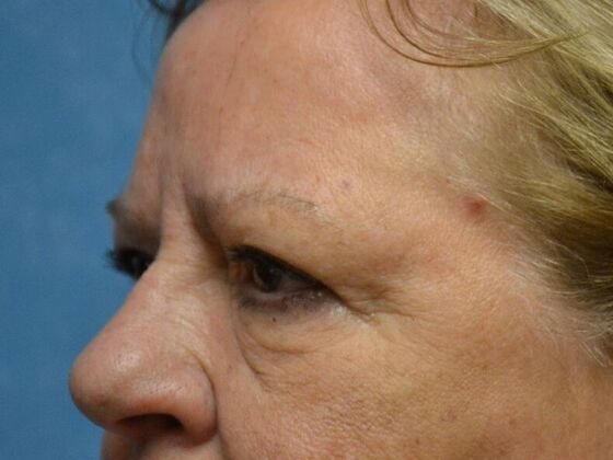 Eye Lift (Blepharoplasty): Case 1573- Oregon, OH - Before