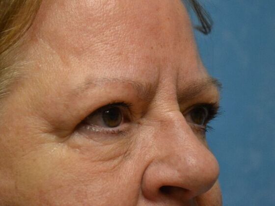 Eye Lift (Blepharoplasty): Case 1573- Oregon, OH - Before