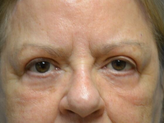 Eye Lift (Blepharoplasty) Case 1573- Oregon, OH - After