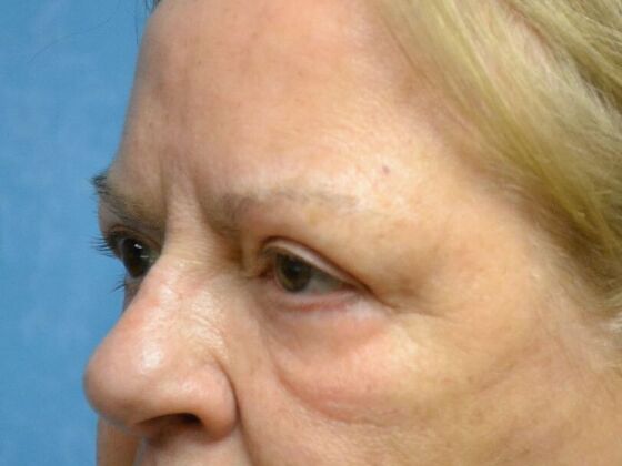 Eye Lift (Blepharoplasty): Case 1573- Oregon, OH - After