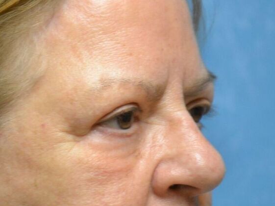 Eye Lift (Blepharoplasty): Case 1573- Oregon, OH - After