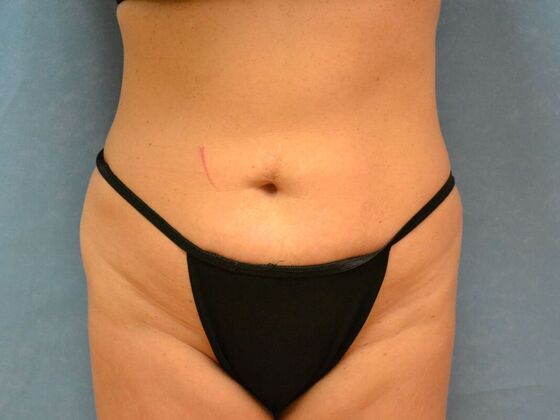 Tummy Tuck Case 1803- Sylvania, OH - Before