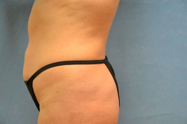 Tummy Tuck: Case 1803- Sylvania, OH - Before