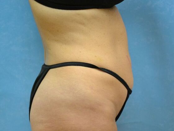 Tummy Tuck: Case 1803- Sylvania, OH - Before