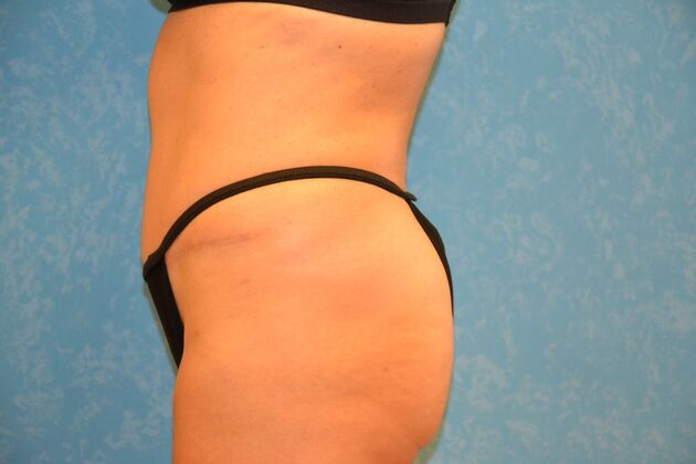 Tummy Tuck: Case 1803- Sylvania, OH - After