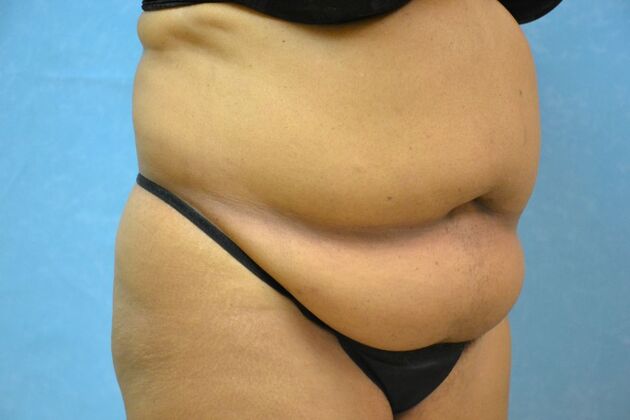 Tummy Tuck: Case 1804- Toledo, OH - Before