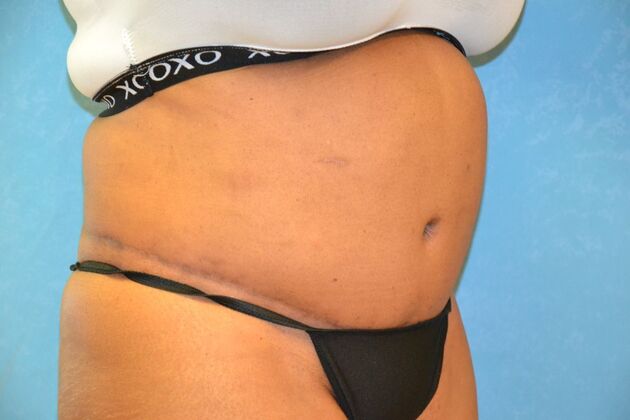 Tummy Tuck: Case 1804- Toledo, OH - After