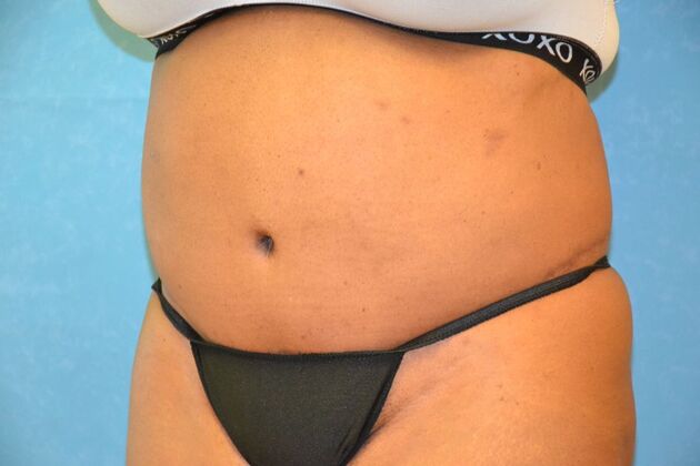 Tummy Tuck: Case 1804- Toledo, OH - After