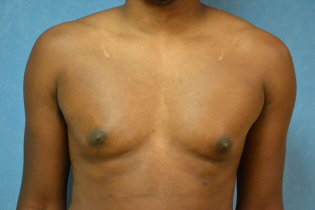 Gynecomastia Case 1511- Lima, OH - Before
