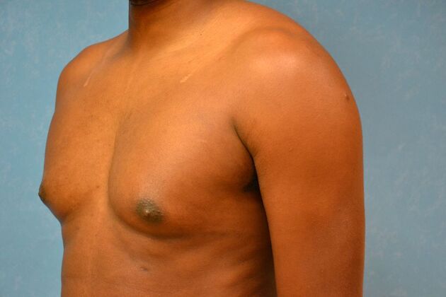 Gynecomastia: Case 1511- Lima, OH - Before