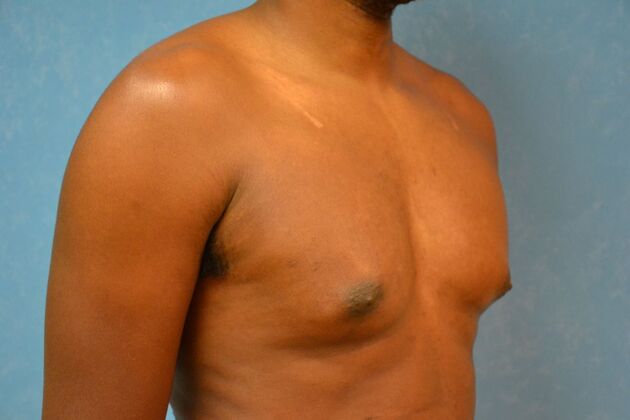 Gynecomastia: Case 1511- Lima, OH - Before