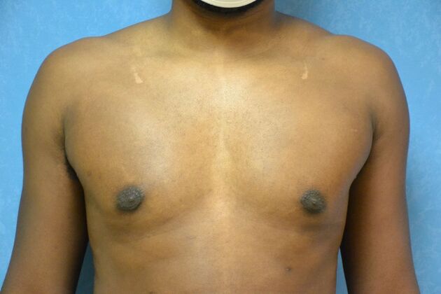 Gynecomastia Case 1511- Lima, OH - After