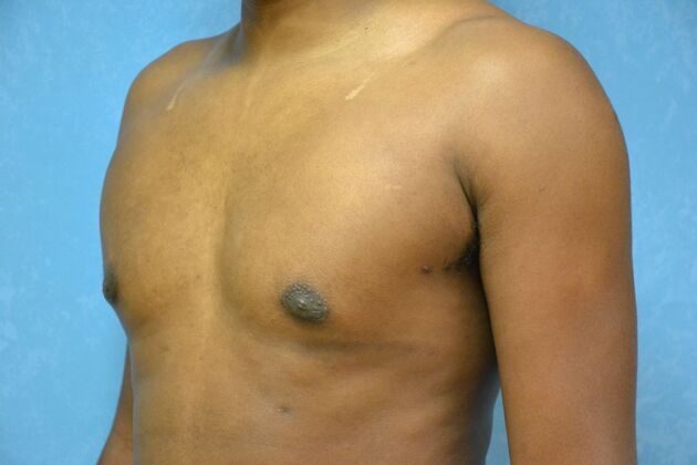 Gynecomastia: Case 1511- Lima, OH - After