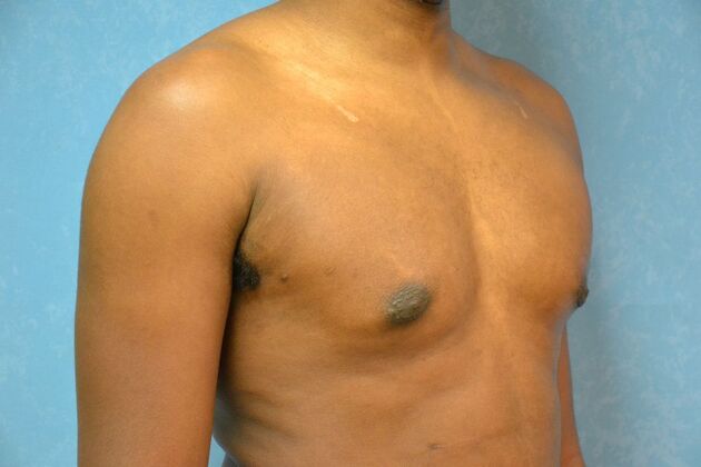 Gynecomastia: Case 1511- Lima, OH - After