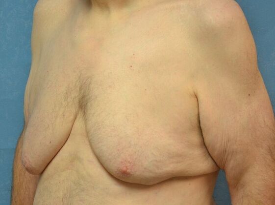 Gynecomastia: Case 1512- Liberty Center, OH - Before
