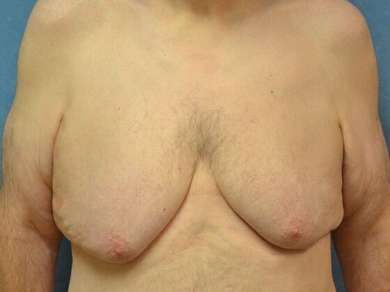 Gynecomastia Case 1512- Liberty Center, OH - Before