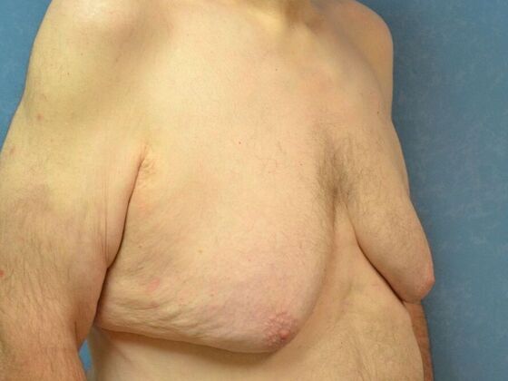 Gynecomastia: Case 1512- Liberty Center, OH - Before