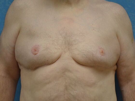 Gynecomastia Case 1512- Liberty Center, OH - After