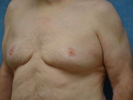 Gynecomastia: Case 1512- Liberty Center, OH - After