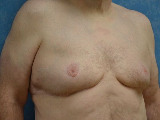 Gynecomastia: Case 1512- Liberty Center, OH - After