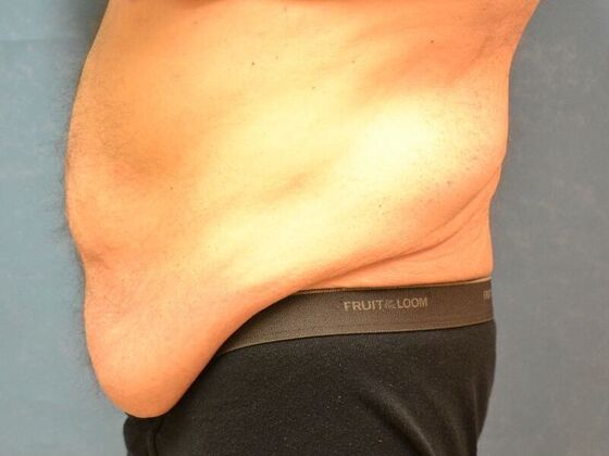 Tummy Tuck: Case 1805- Liberty Center, OH - Before