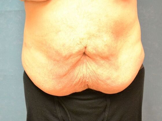 Tummy Tuck Case 1805- Liberty Center, OH - Before